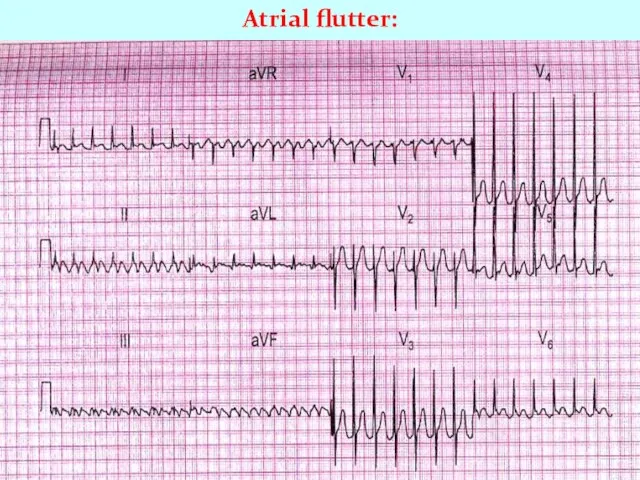 Atrial flutter: