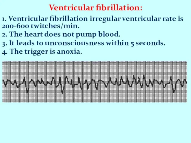 Ventricular fibrillation: 1. Ventricular fibrillation irregular ventricular rate is 200-600 twitches/min.