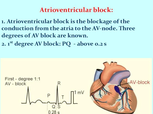 Atrioventricular block: 1. Atrioventricular block is the blockage of the conduction