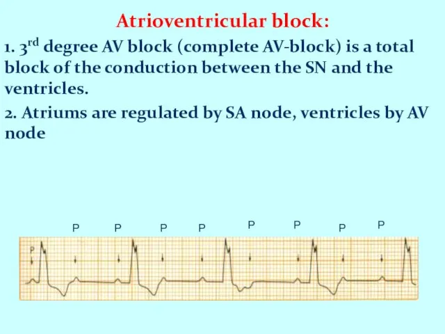 Atrioventricular block: 1. 3rd degree AV block (complete AV-block) is a