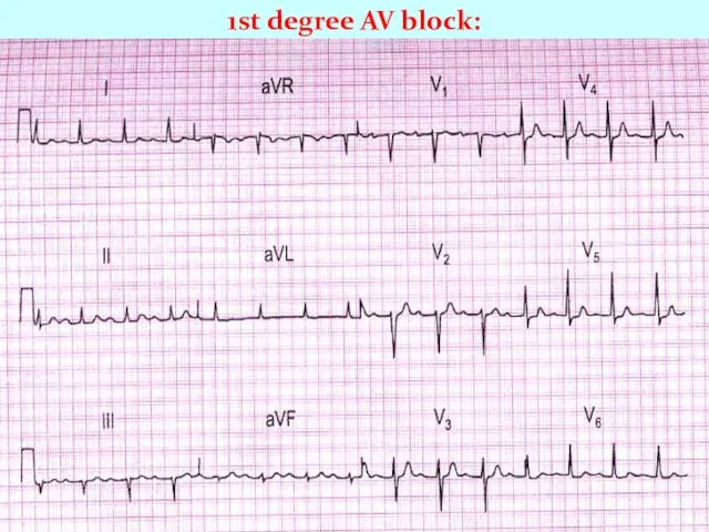 1st degree AV block: