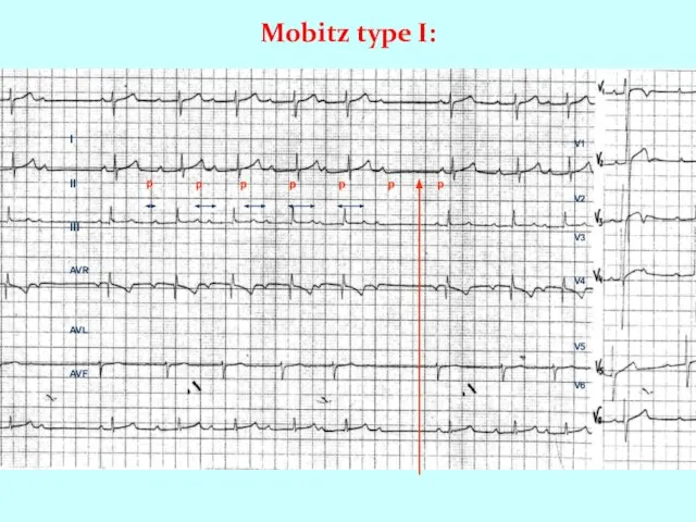 Mobitz type I: I II III AVR AVL AVF V1 V2