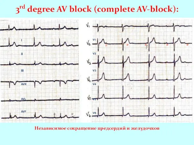 3rd degree AV block (complete AV-block): I II III AVR AVL