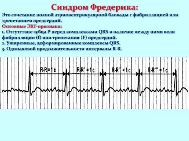 Синдром Фредерика: Это сочетание полной атриовентрикулярной блокады с фибрилляцией или трепетанием