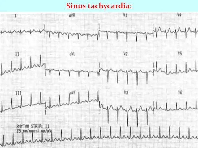 Sinus tachycardia: