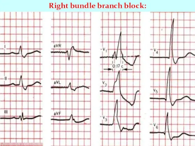 Right bundle branch block: