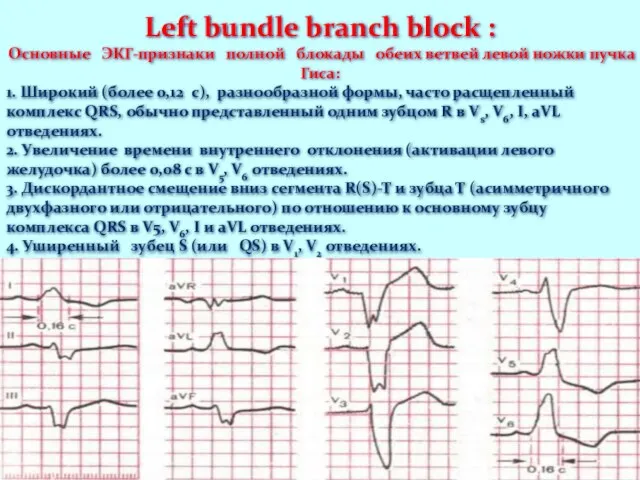 Left bundle branch block : Основные ЭКГ-признаки полной блокады обеих ветвей