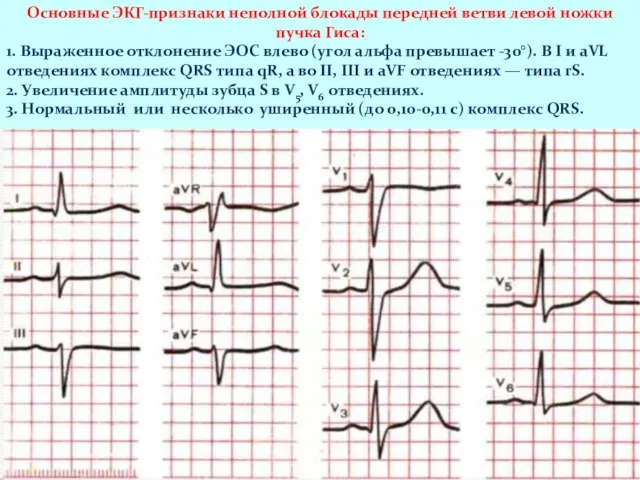 Основные ЭКГ-признаки неполной блокады передней ветви левой ножки пучка Гиса: 1.