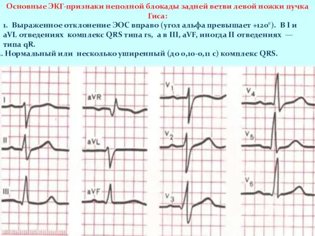 Основные ЭКГ-признаки неполной блокады задней ветви левой ножки пучка Гиса: 1.