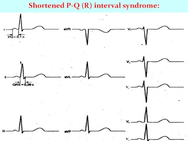 Shortened P-Q (R) interval syndrome: