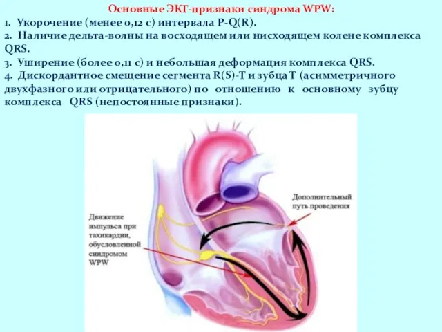 Основные ЭКГ-признаки синдрома WPW: 1. Укорочение (менее 0,12 с) интервала P-Q(R).