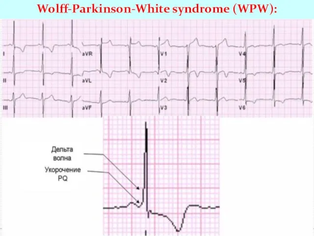 Wolff-Parkinson-White syndrome (WPW):