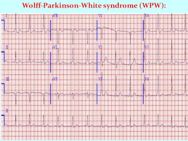 Wolff-Parkinson-White syndrome (WPW):