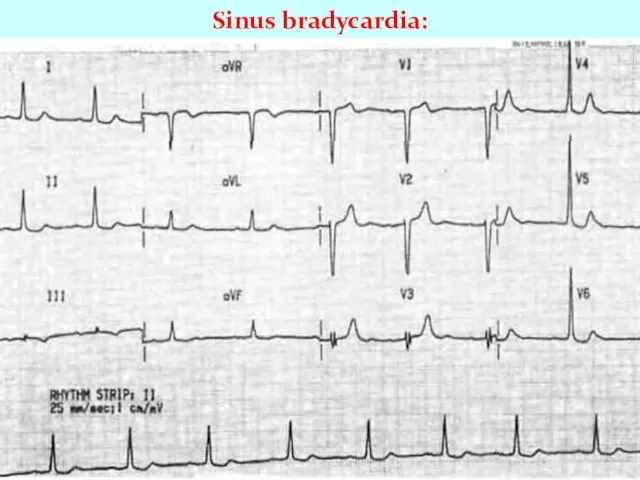 Sinus bradycardia: