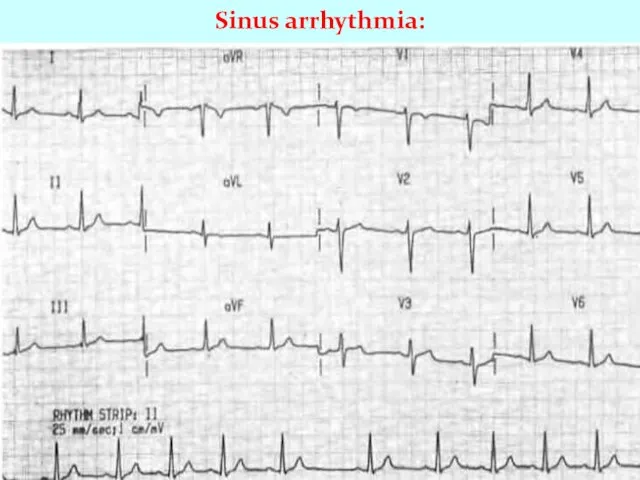 Sinus arrhythmia: