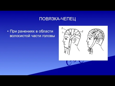 ПОВЯЗКА-ЧЕПЕЦ При ранениях в области волосистой части головы