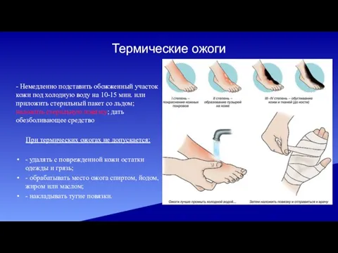 Термические ожоги - Немедленно подставить обожженный участок кожи под холодную воду