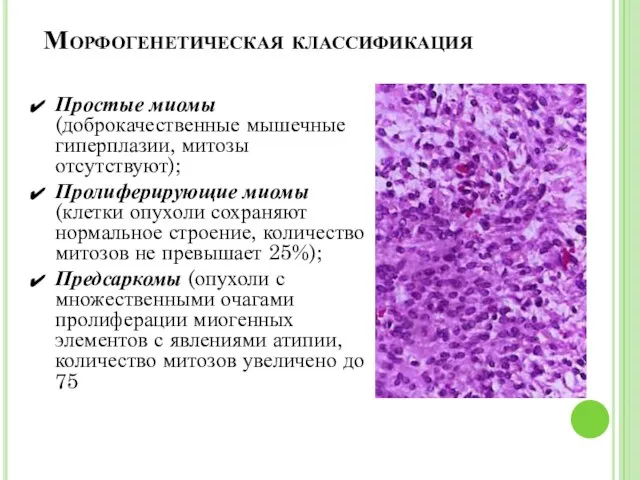 Морфогенетическая классификация Простые миомы (доброкачественные мышечные гиперплазии, митозы отсутствуют); Пролиферирующие миомы