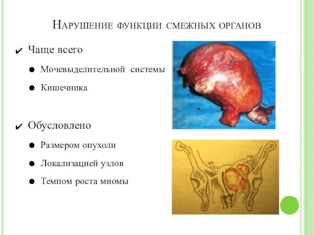 Нарушение функции смежных органов Чаще всего Мочевыделительной системы Кишечника Обусловлено Размером