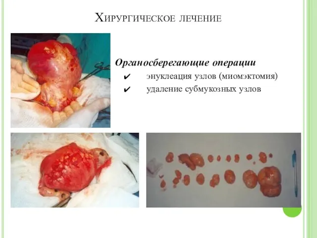Хирургическое лечение Органосберегающие операции энуклеация узлов (миомэктомия) удаление субмукозных узлов