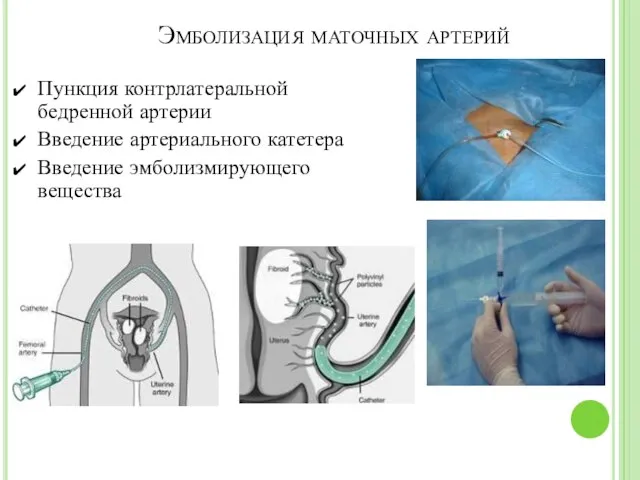 Эмболизация маточных артерий Пункция контрлатеральной бедренной артерии Введение артериального катетера Введение эмболизмирующего вещества