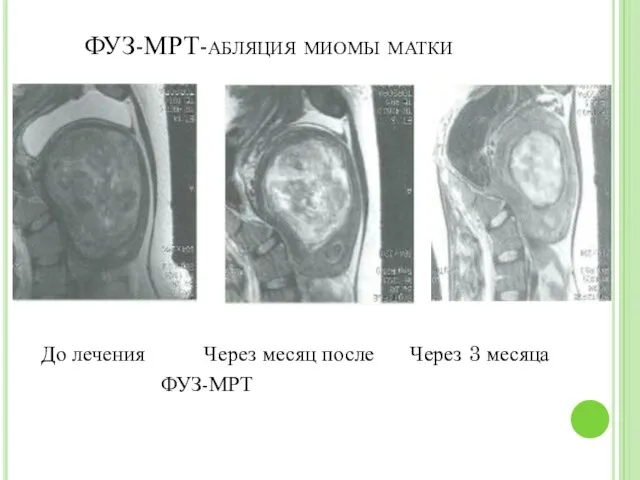 ФУЗ-МРТ-абляция миомы матки До лечения Через месяц после Через 3 месяца ФУЗ-МРТ