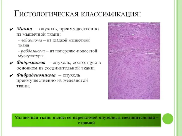 Гистологическая классификация: Миома – опухоль, преимущественно из мышечной ткани; - лейомиома