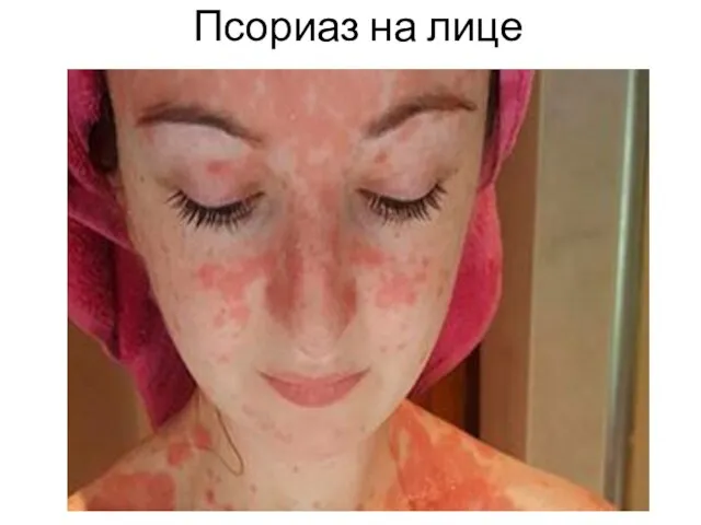 Псориаз на лице