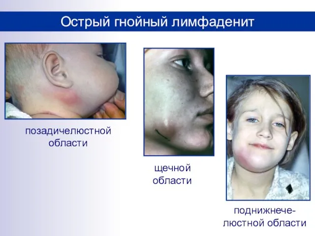 Острый гнойный лимфаденит позадичелюстной области щечной области поднижнече-люстной области