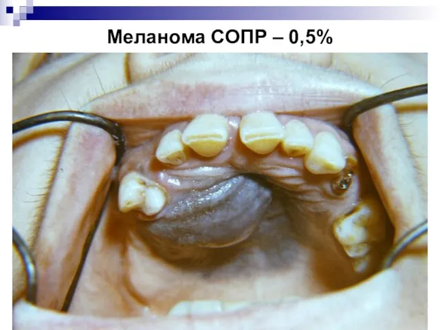 Меланома СОПР – 0,5%