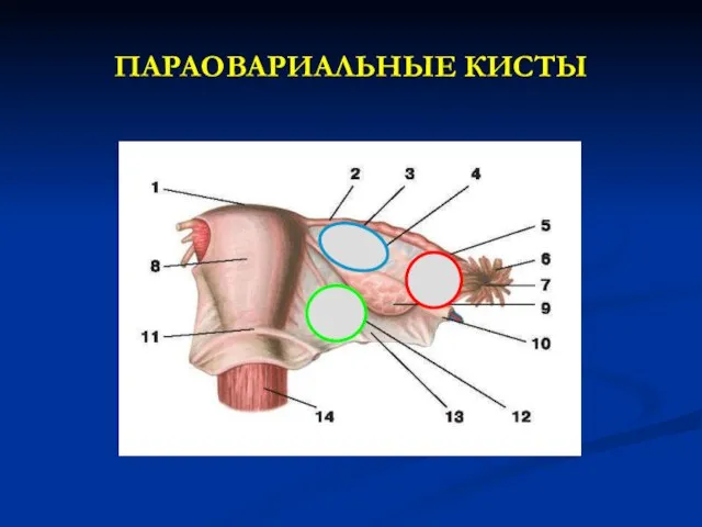 ПАРАОВАРИАЛЬНЫЕ КИСТЫ