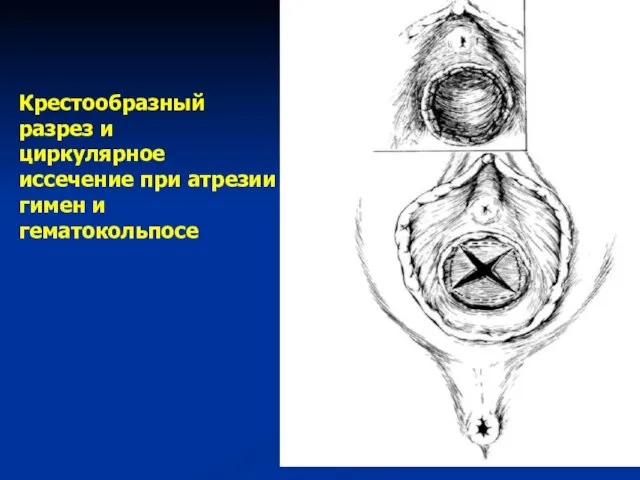 Крестообразный разрез и циркулярное иссечение при атрезии гимен и гематокольпосе