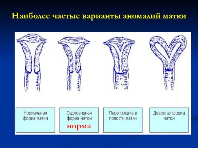 Наиболее частые варианты аномалий матки норма