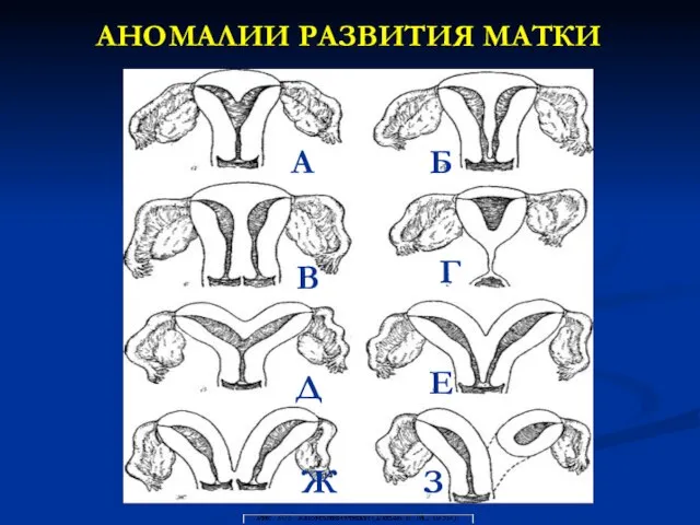 АНОМАЛИИ РАЗВИТИЯ МАТКИ А В Д Ж Б Г Е З