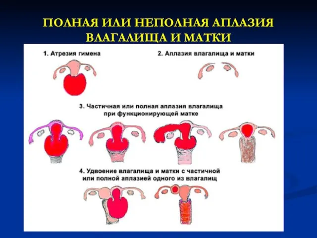 ПОЛНАЯ ИЛИ НЕПОЛНАЯ АПЛАЗИЯ ВЛАГАЛИЩА И МАТКИ