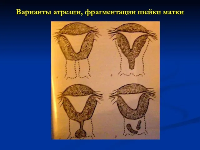 Варианты атрезии, фрагментации шейки матки