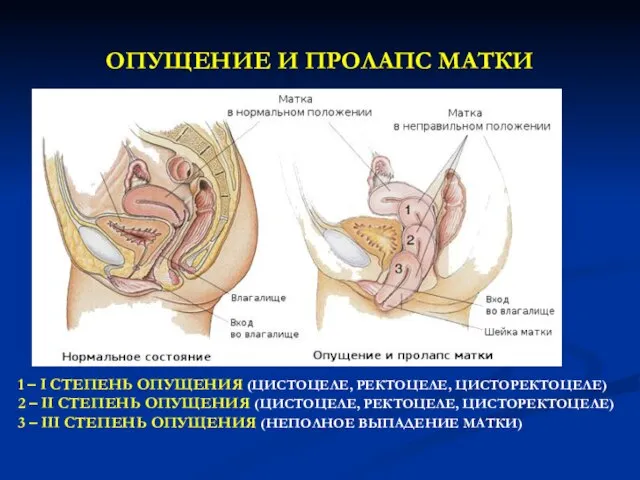 ОПУЩЕНИЕ И ПРОЛАПС МАТКИ 1 – I СТЕПЕНЬ ОПУЩЕНИЯ (ЦИСТОЦЕЛЕ, РЕКТОЦЕЛЕ,