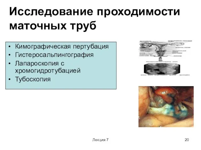 Лекция 7 Исследование проходимости маточных труб Кимографическая пертубация Гистеросальпингография Лапароскопия с хромогидротубацией Тубоскопия