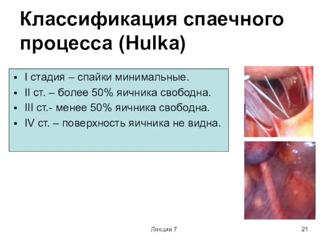 Лекция 7 Классификация спаечного процесса (Hulka) I стадия – спайки минимальные.