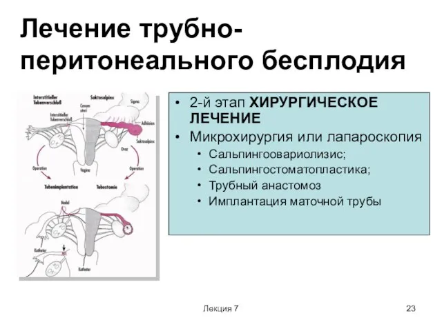 Лекция 7 Лечение трубно-перитонеального бесплодия 2-й этап ХИРУРГИЧЕСКОЕ ЛЕЧЕНИЕ Микрохирургия или