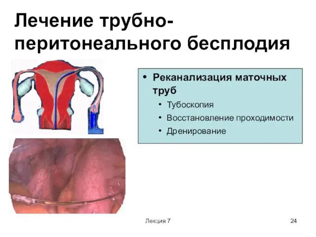 Лекция 7 Лечение трубно-перитонеального бесплодия Реканализация маточных труб Тубоскопия Восстановление проходимости Дренирование