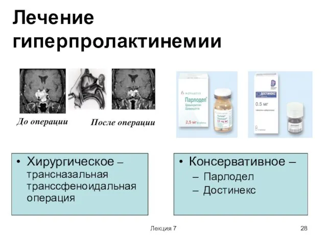 Лекция 7 Лечение гиперпролактинемии Хирургическое – трансназальная транссфеноидальная операция Консервативное –