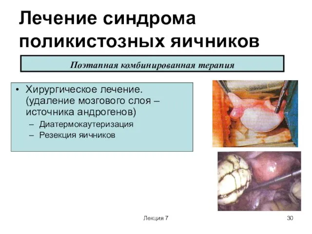 Лекция 7 Лечение синдрома поликистозных яичников Хирургическое лечение. (удаление мозгового слоя