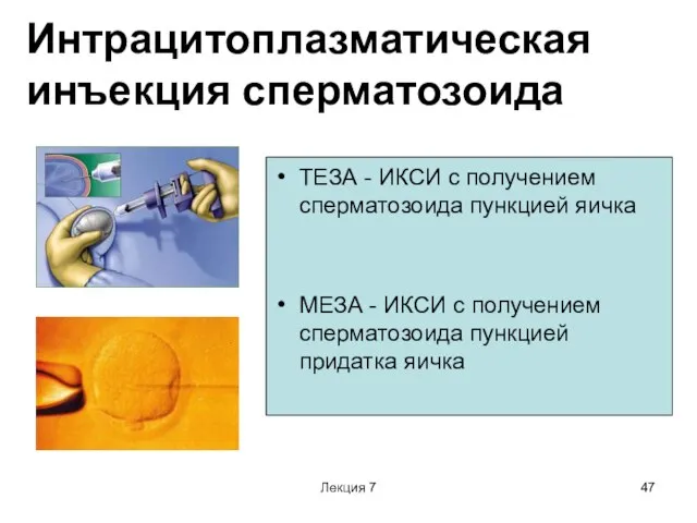 Лекция 7 Интрацитоплазматическая инъекция сперматозоида ТЕЗА - ИКСИ с получением сперматозоида