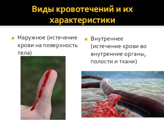 Виды кровотечений и их характеристики Наружное (истечение крови на поверхность тела)