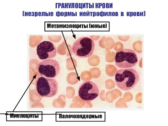 ГРАНУЛОЦИТЫ КРОВИ (незрелые формы нейтрофилов в крови) Метамиэлоциты (юные) Миелоциты Палочкоядерные