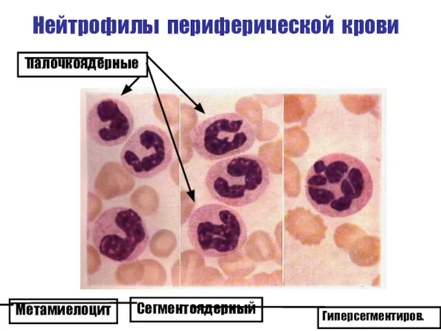 Нейтрофилы периферической крови Метамиелоцит Палочкоядерные Сегментоядерный Гиперсегментиров.