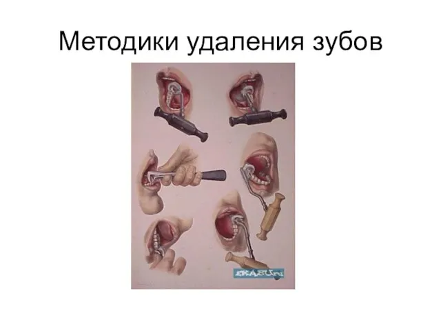 Методики удаления зубов