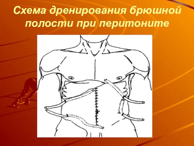 Схема дренирования брюшной полости при перитоните