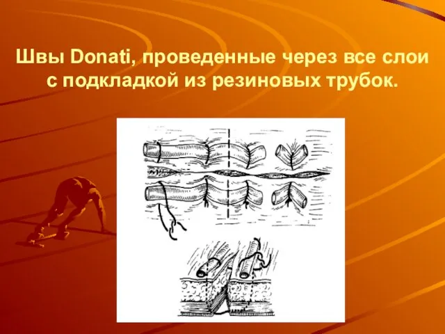 Швы Donati, проведенные через все слои с подкладкой из резиновых трубок.